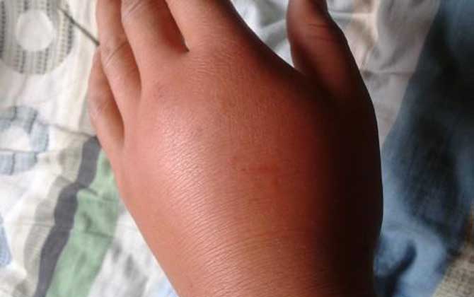 地雷蜂咬人傷口圖片及處理方法 地雷蜂