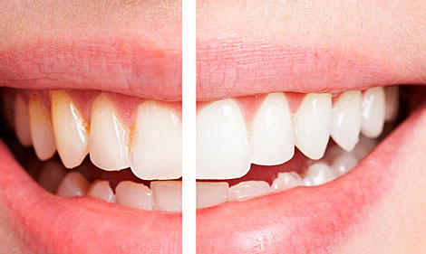 牙齒初老的信號有哪些 牙齒開始“衰老”的三大癥狀,你可要當心了